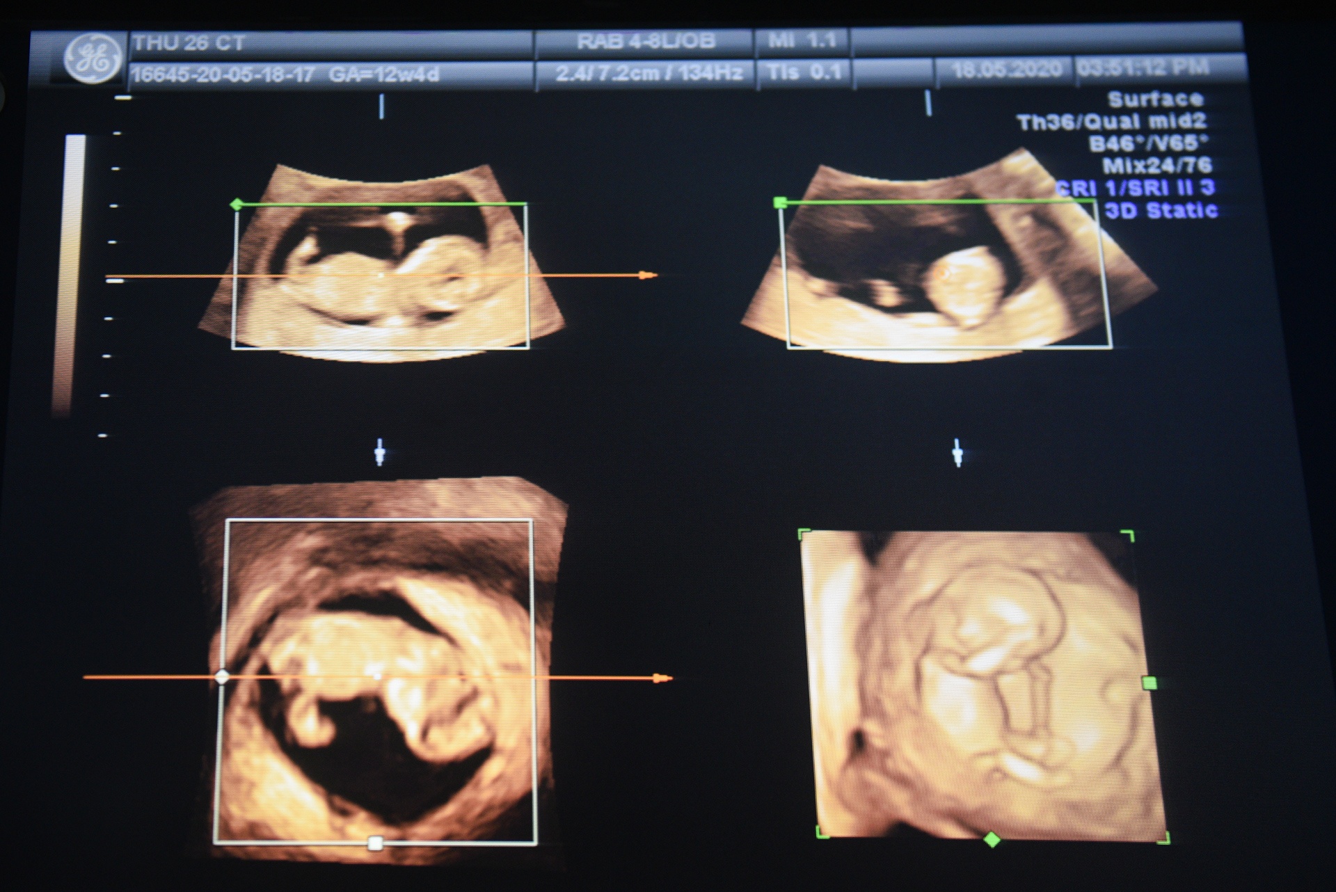 Cap doi cung mat 1 chan anh 23