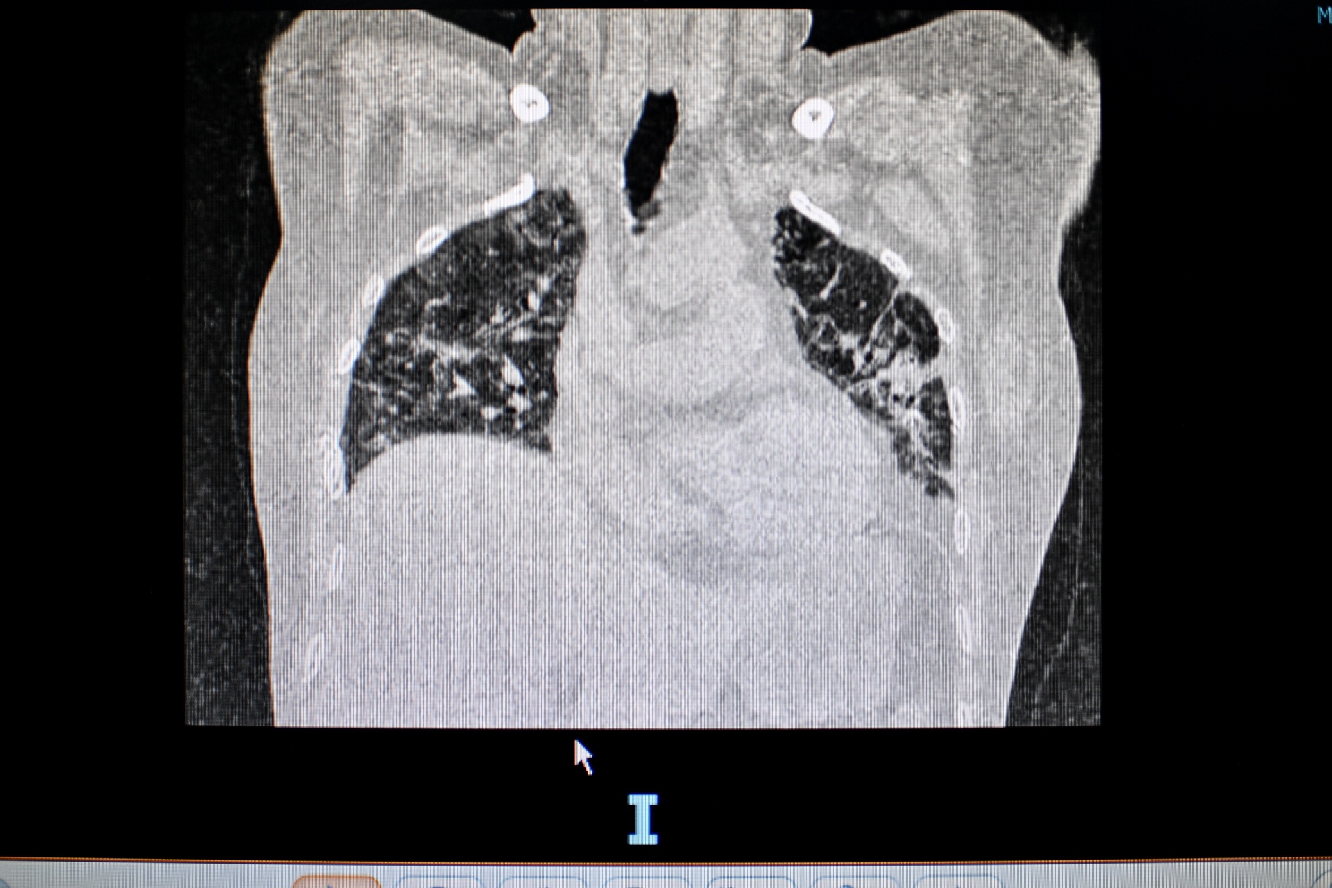 Ai de mac di chung hau Covid-19 anh 2