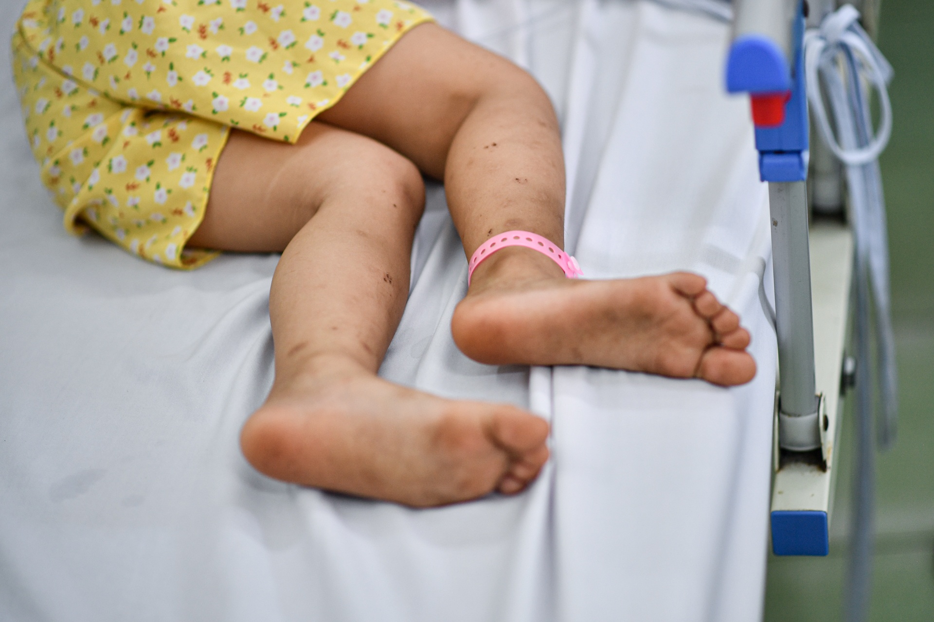 Tay chan mieng,  TP.HCM,  khoa nhi,  benh vien,  nhi dong 2 anh 5