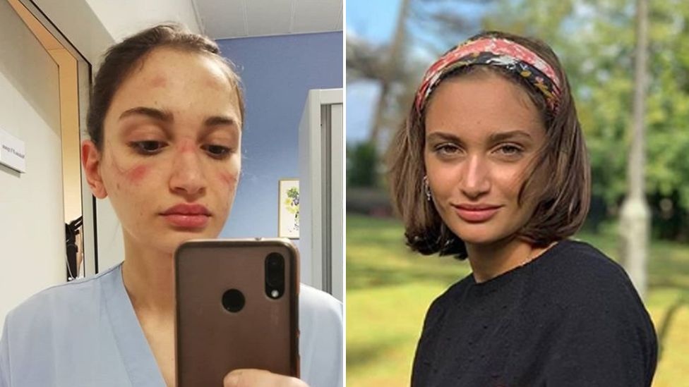 Hinh anh vet bam tren mat y ta lot ta cuoc chien chong dich o Italy hinh anh