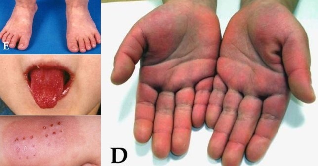 Bac si Anh theo doi lien he giua Covid-19 va benh Kawasaki o tre em hinh anh