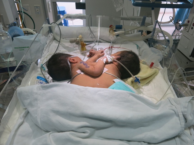 8 ngay chien dau gianh su song cho hai be dinh lien hinh anh