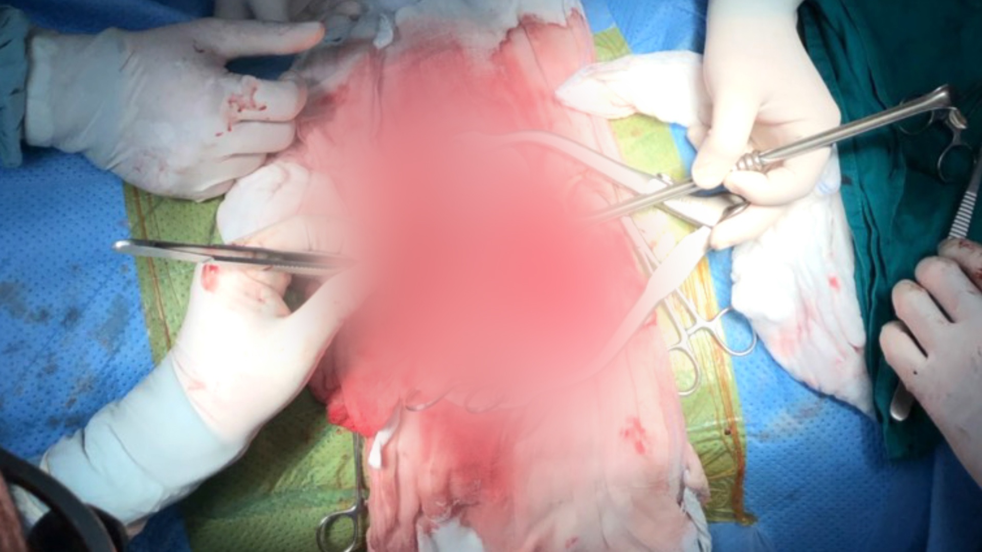 Con duong xuyen Viet cua qua than cho benh nhi dau tien o Viet Nam hinh anh