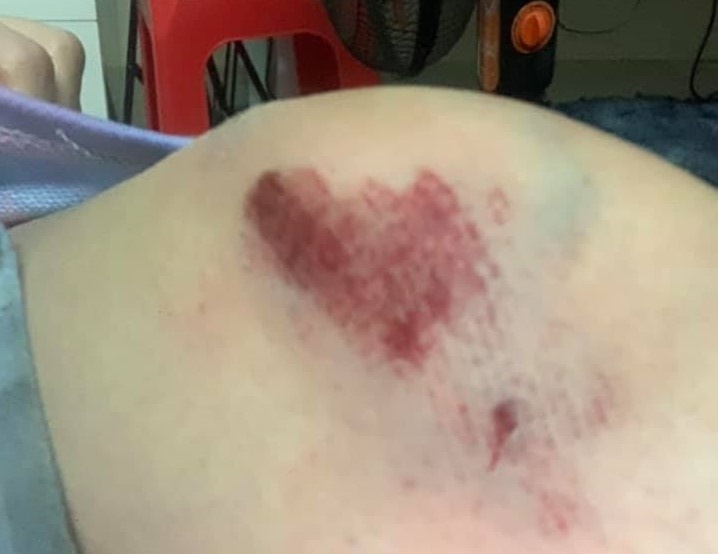 Co gai bi cuop keo le o TP.HCM hinh anh