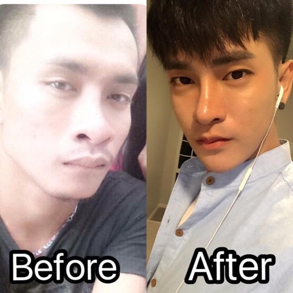 chàng trai Thái Lan phẫu thuật thẩm mỹ ảnh 1 chang trai Thai Lan phau thuat tham my anh 1