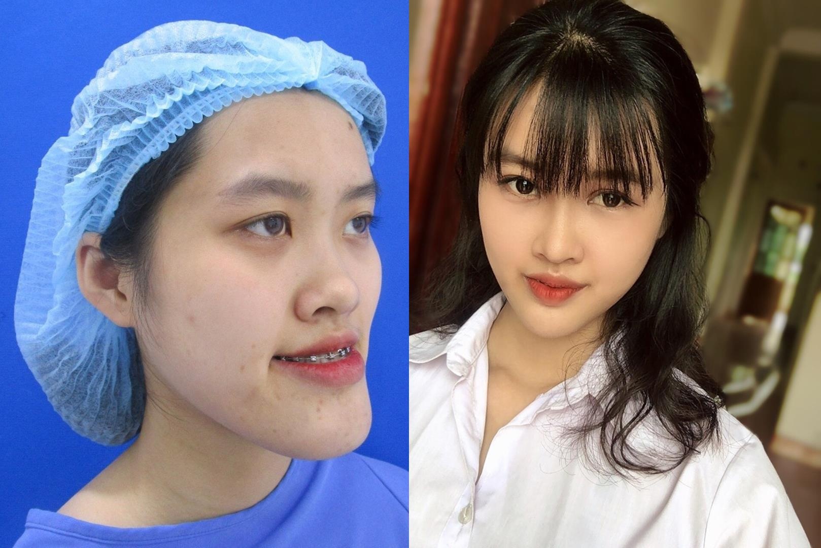 Nu sinh Canh sat va cac co gai 'lot xac' sau khi phau thuat tham my hinh anh