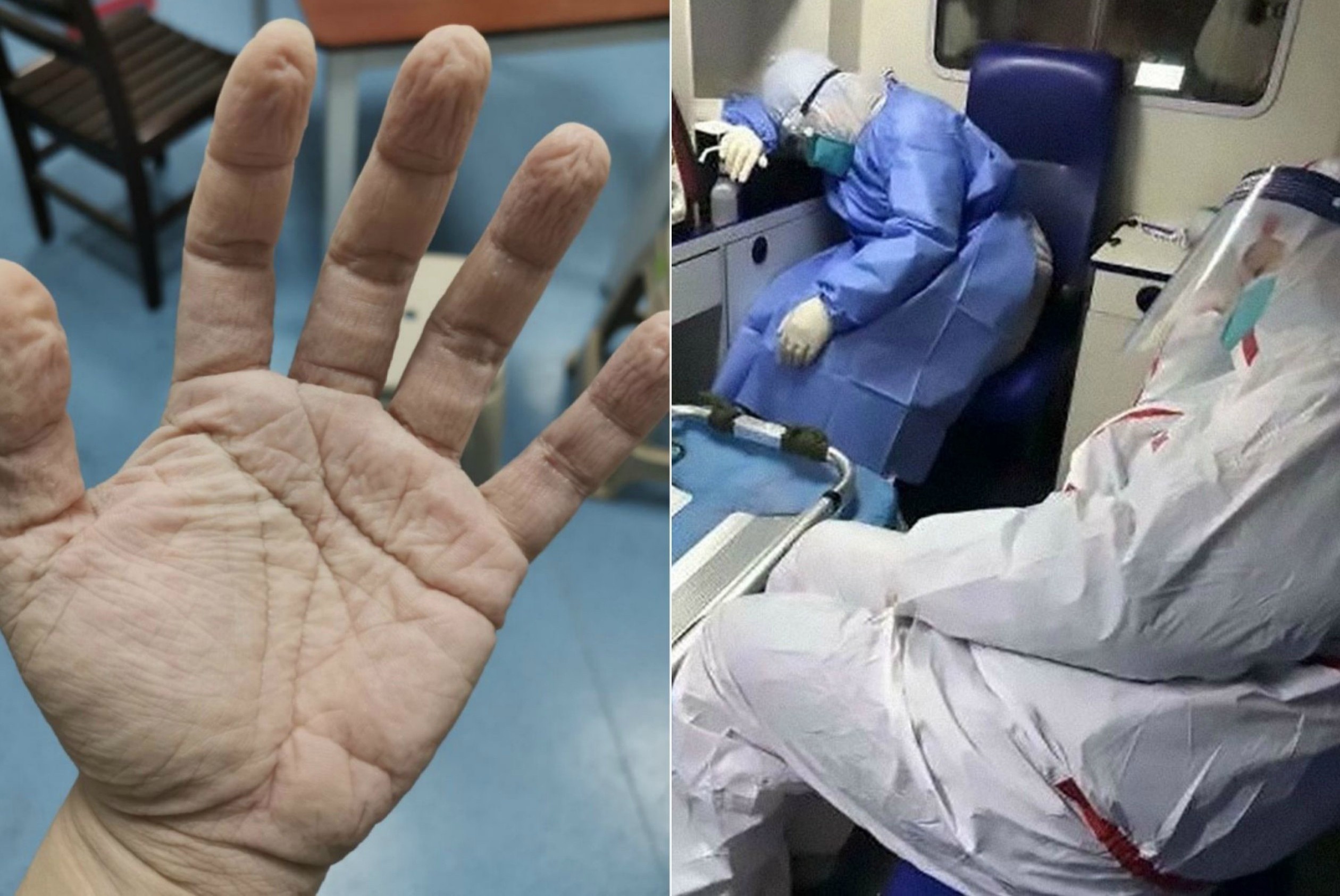 Bac si Vu Han mat han khau trang, dau cao troc vi chong dich corona hinh anh