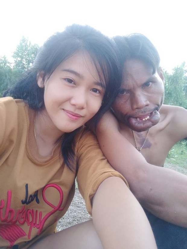 cô gái lấy chàng trai dị tật môi ảnh 5 co gai lay chang trai di tat moi anh 5