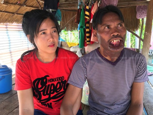 cô gái lấy chàng trai dị tật môi ảnh 2 co gai lay chang trai di tat moi anh 2