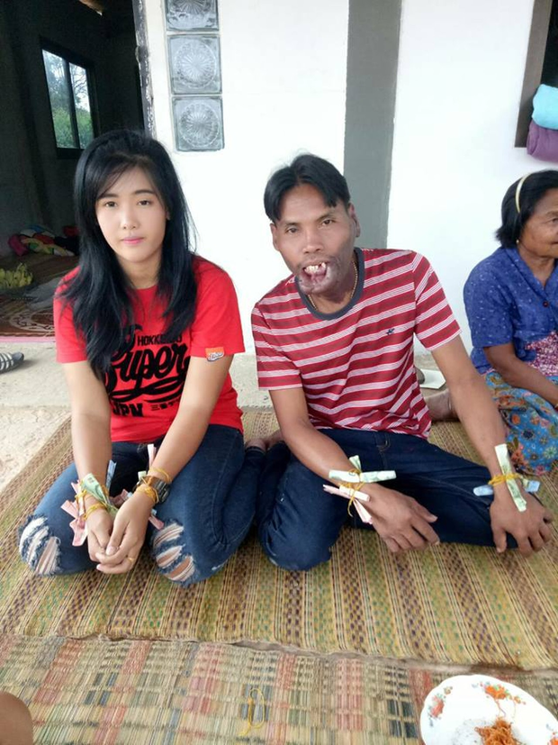 cô gái lấy chàng trai dị tật môi ảnh 4 co gai lay chang trai di tat moi anh 4