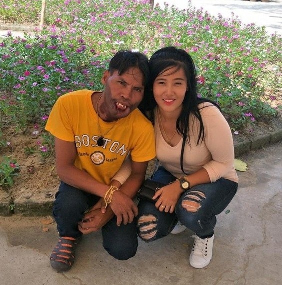 cô gái lấy chàng trai dị tật môi ảnh 1 co gai lay chang trai di tat moi anh 1