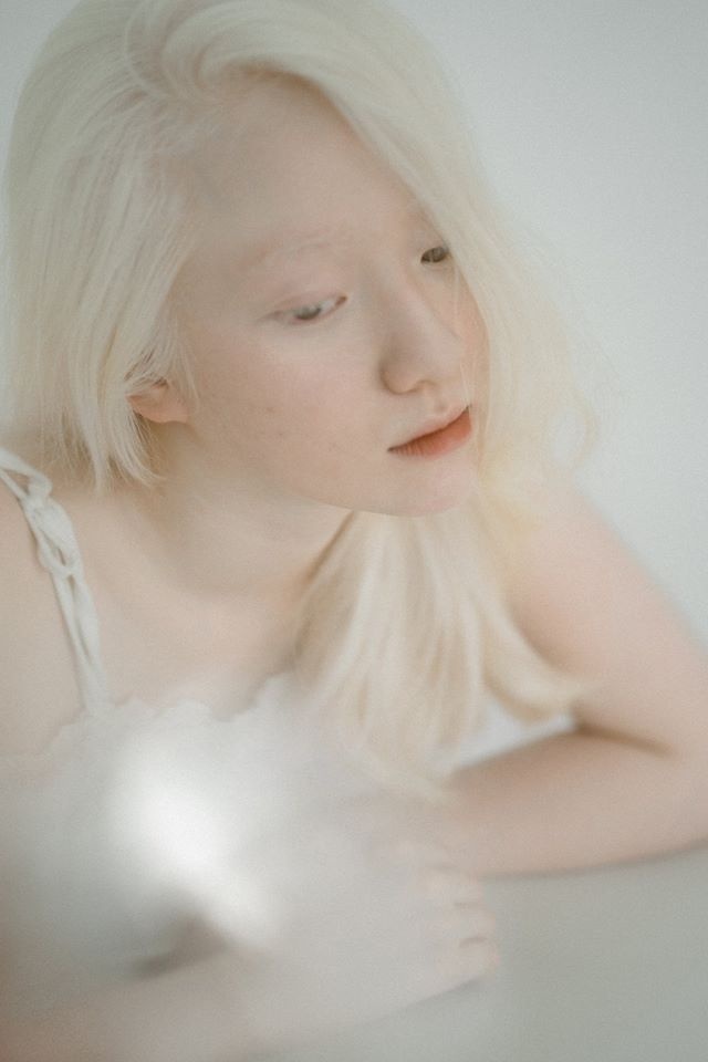 nữ sinh Hà Nội bạch tạng ảnh 3 nu sinh Ha Noi bach tang anh 3