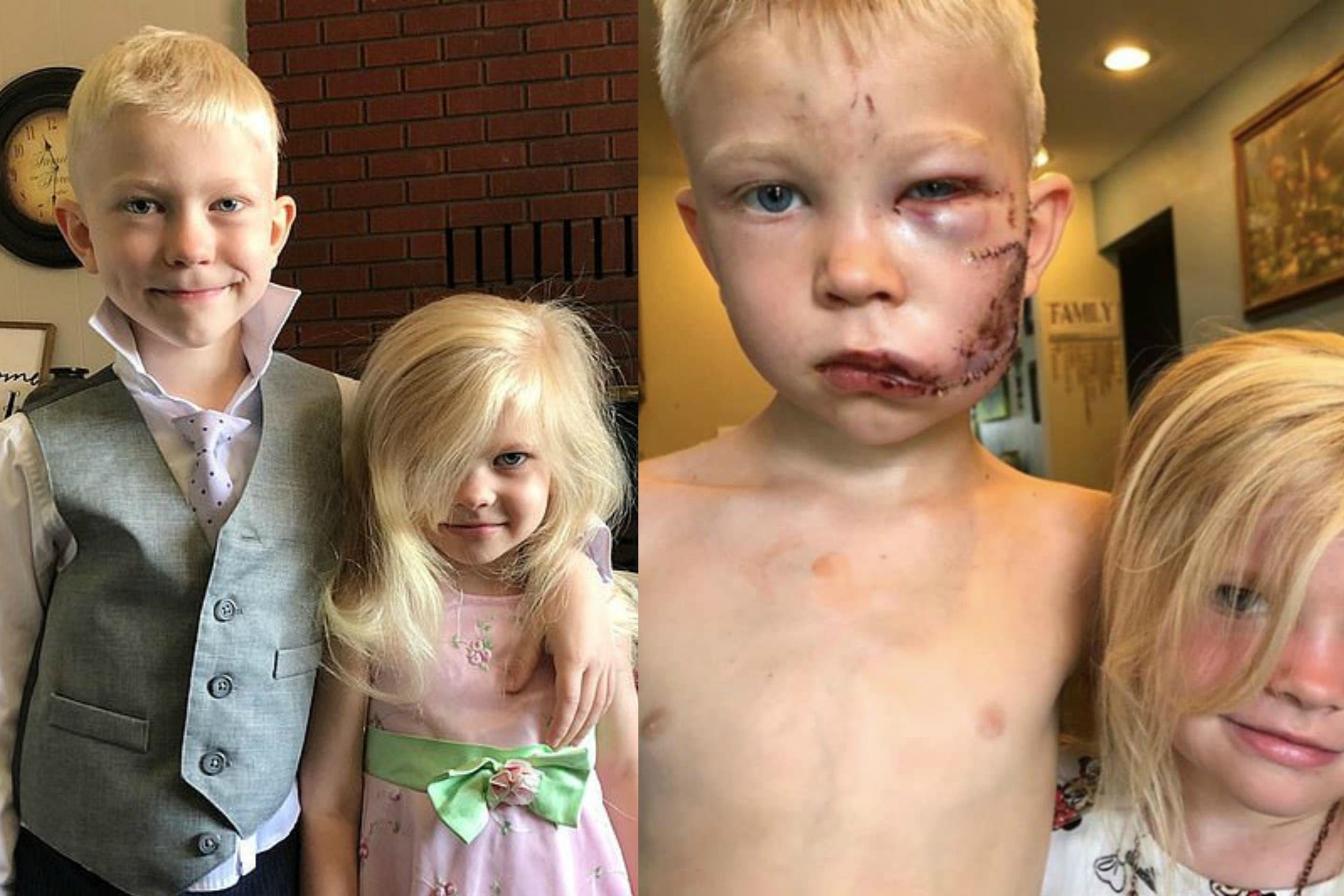 Be trai 6 tuoi phai khau 90 mui sau khi cuu em khoi cho du hinh anh