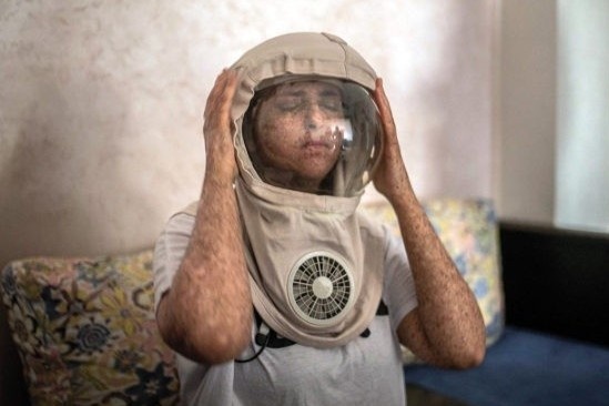 Co gai di ung anh Mat Troi, 20 nam ra ngoai phai doi mu phi hanh gia hinh anh