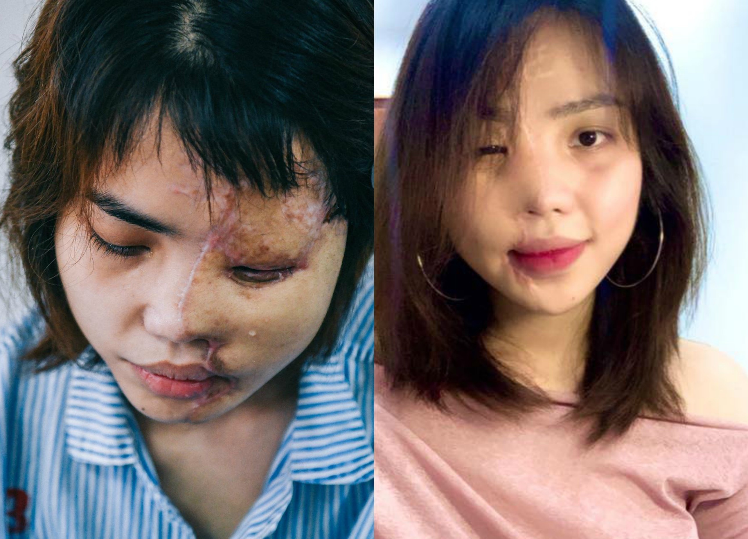 Co gai bi tat axit dan hoi phuc sau gan 2 nam hinh anh