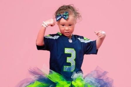 Lan da dong vay do benh hiem gap cua nguoi mau nhi hinh anh