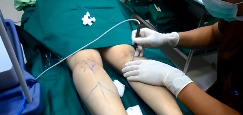 phau thuat lam chan thon anh 2