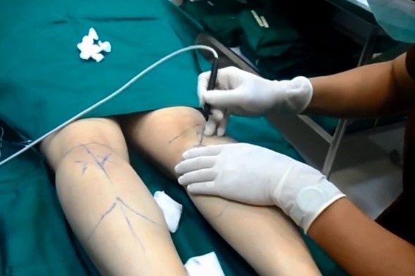 Danh cuoc tinh mang, cat day than kinh de co chan thon hinh anh