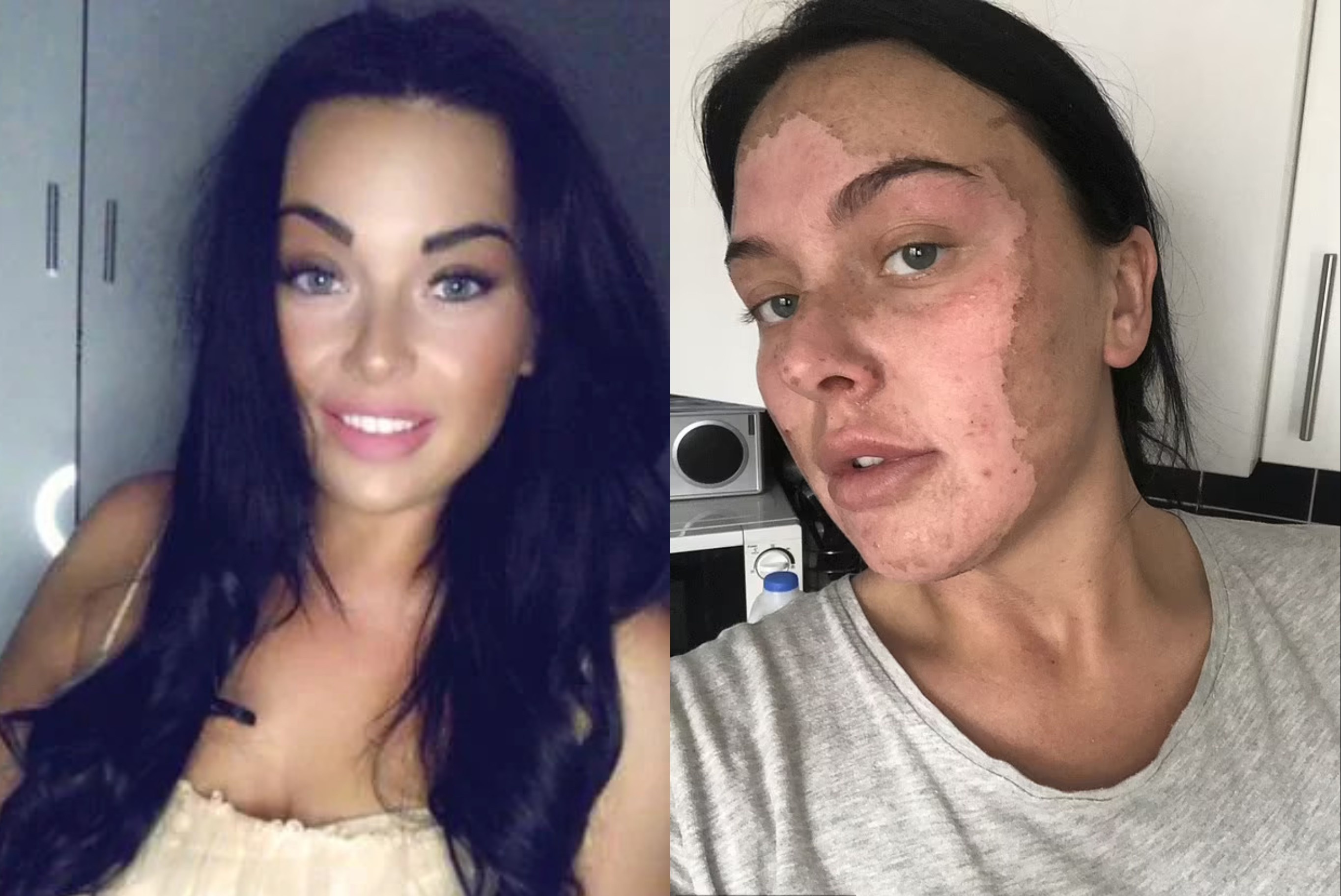 Co gai Anh bong mat vi nau trung theo TikTok hinh anh