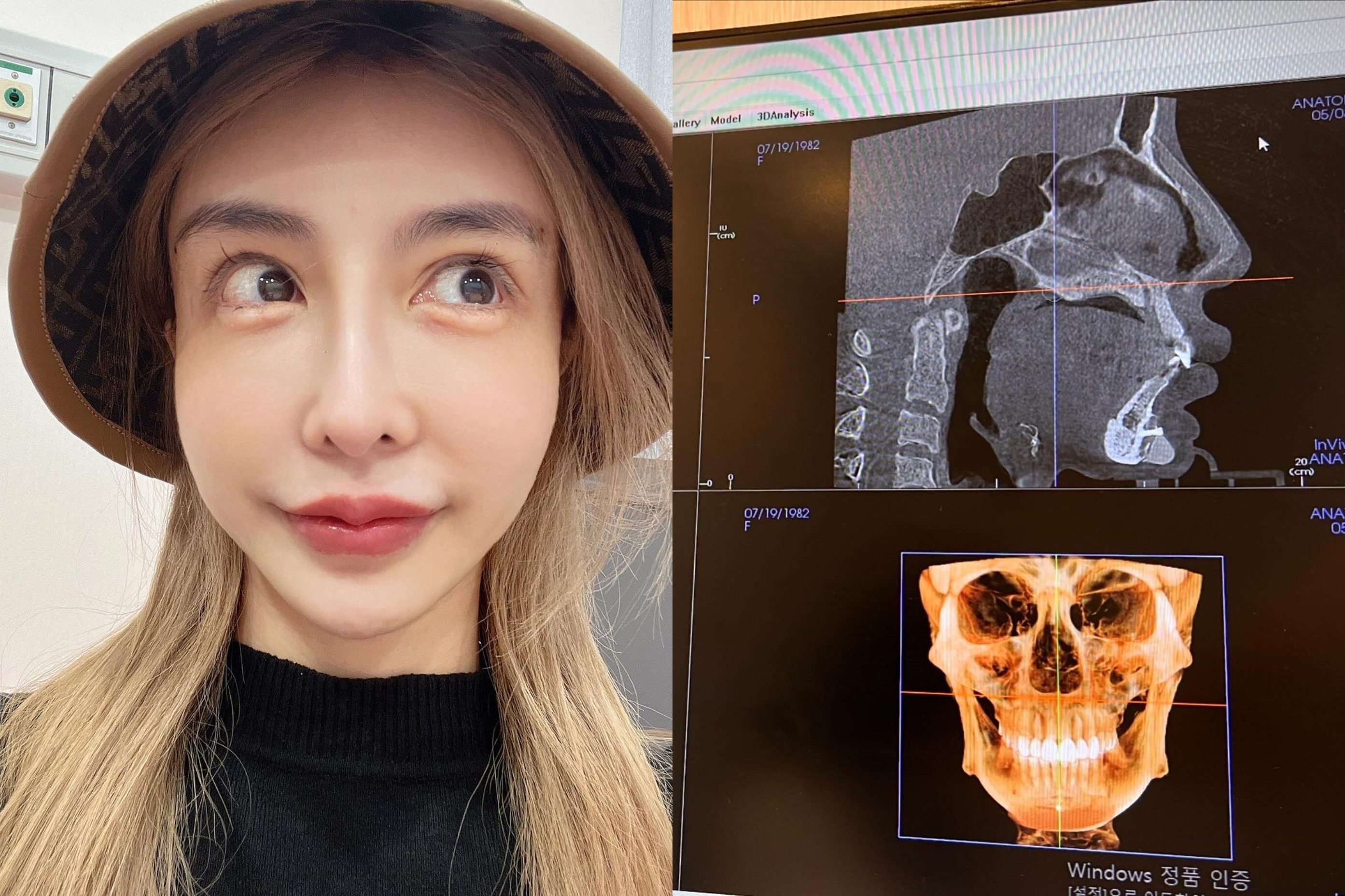 Anh chup X-quang gay soc cua nguoi mau nghien dao keo hinh anh