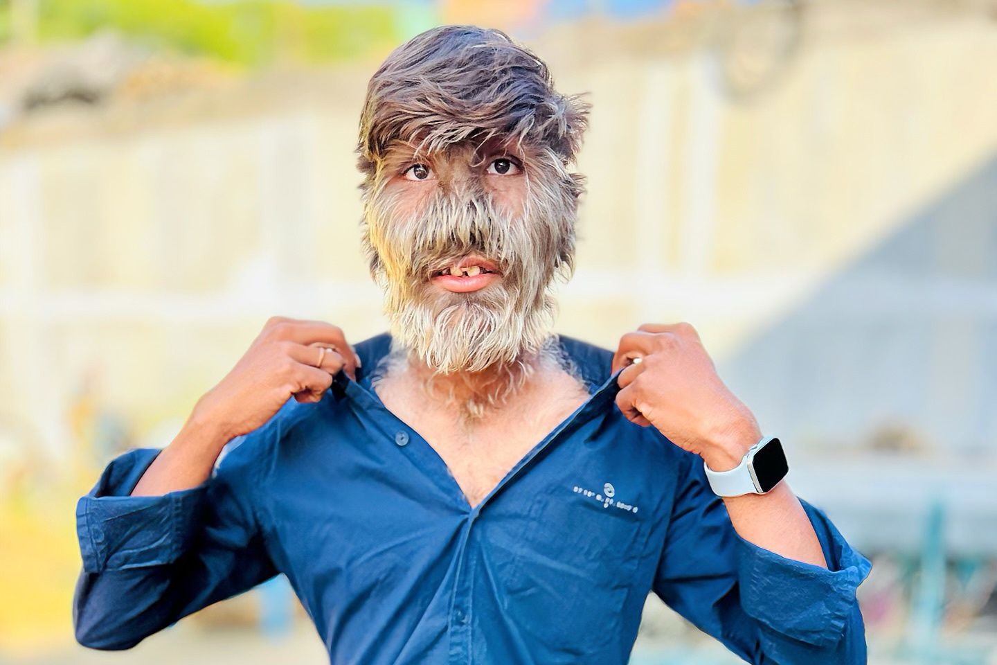 'Nguoi soi' doi thuc co long bao phu 95% khuon mat hinh anh