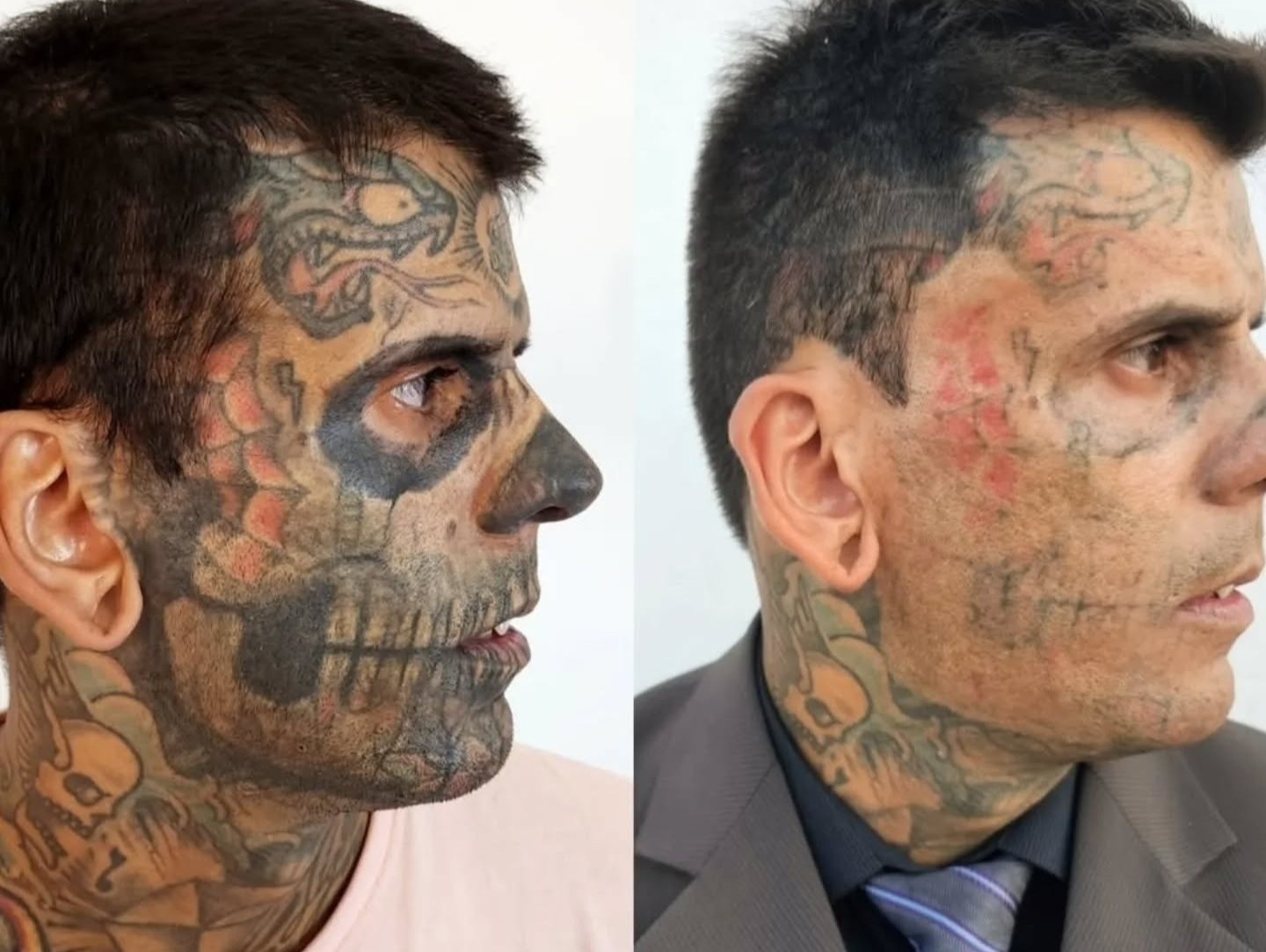 xóa xăm kín thân ảnh 5 xoa xam kin than anh 5