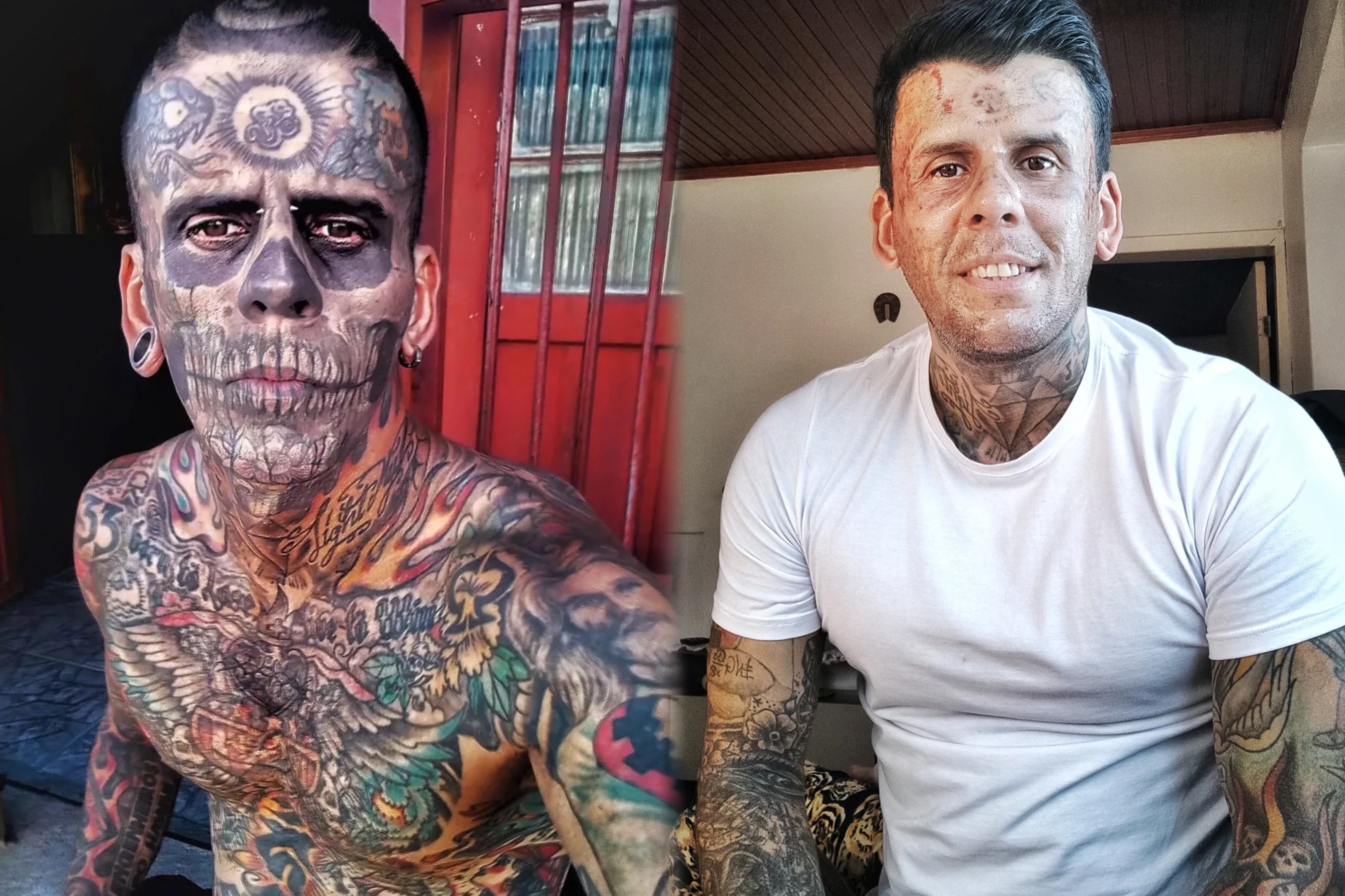 Qua trinh xoa xam dau don cua nguoi dan ong 'phu muc' 95% co the hinh anh