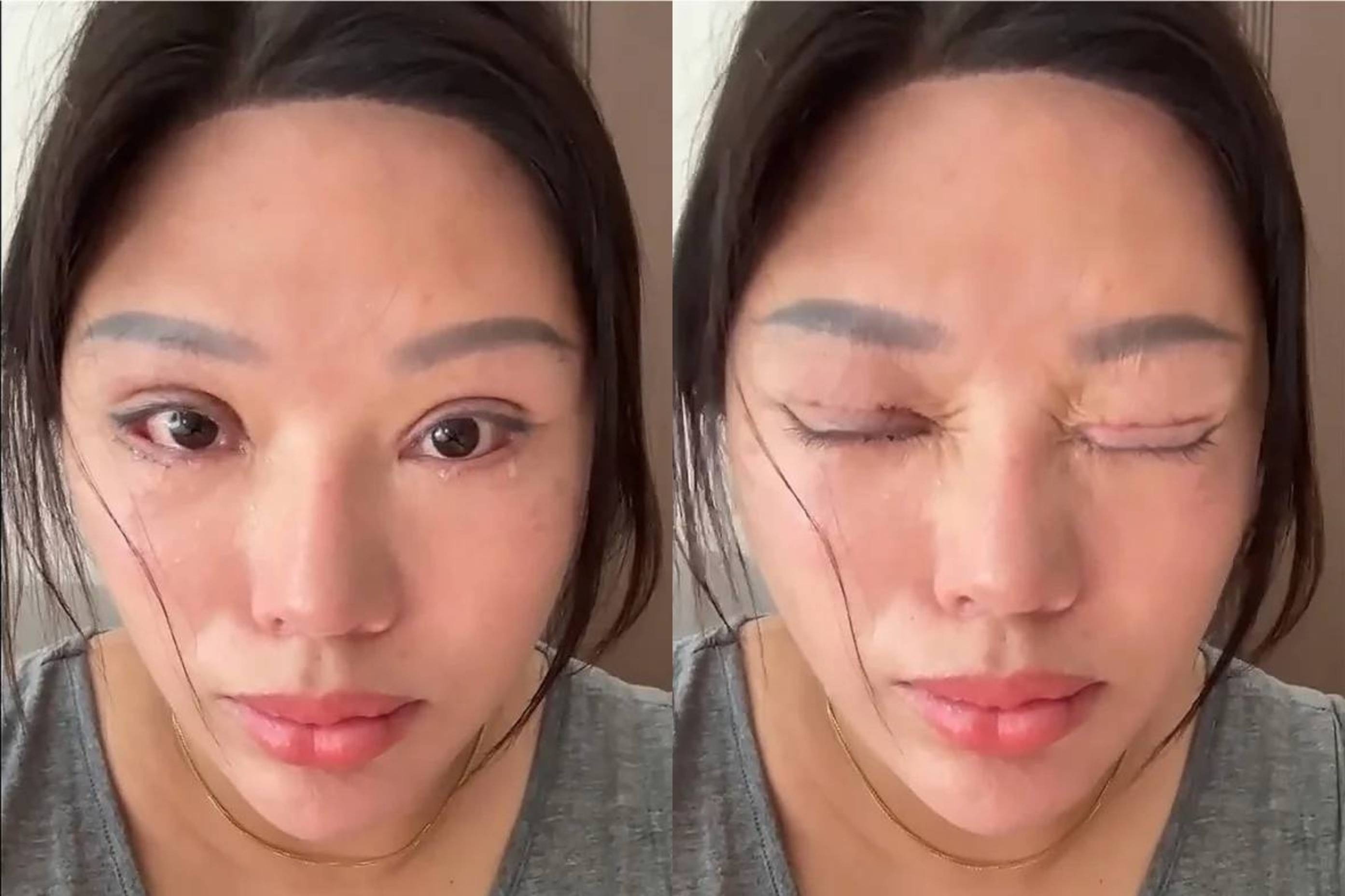Nguoi phu nu Trung Quoc 6 nam 'ngu khong nham mat' vi cat mi hong hinh anh