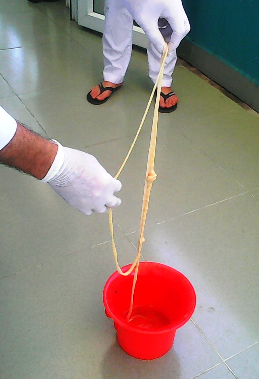 sán xơ mít dài 5 mét trong bụng cụ bà 82 tuổi ảnh 1 san xo mit dai 5 met trong bung cu ba 82 tuoi anh 1