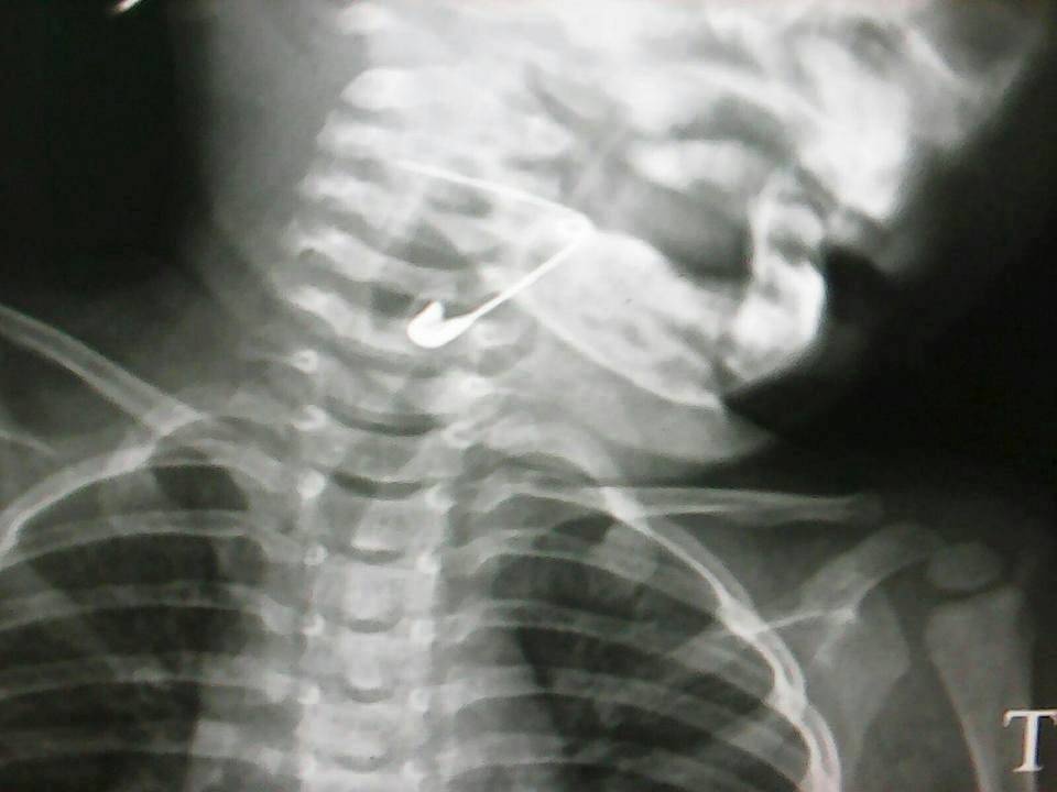 Gap thanh cong kim bang dai hon 3 cm trong thanh quan be gai hinh anh