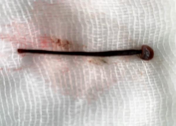 Nu sinh vien rua mat o suoi bi dia chui vao mui hinh anh