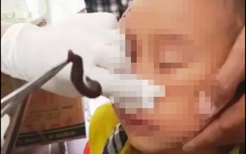 Be gai 8 tuoi bi dia chui vao mui hinh anh