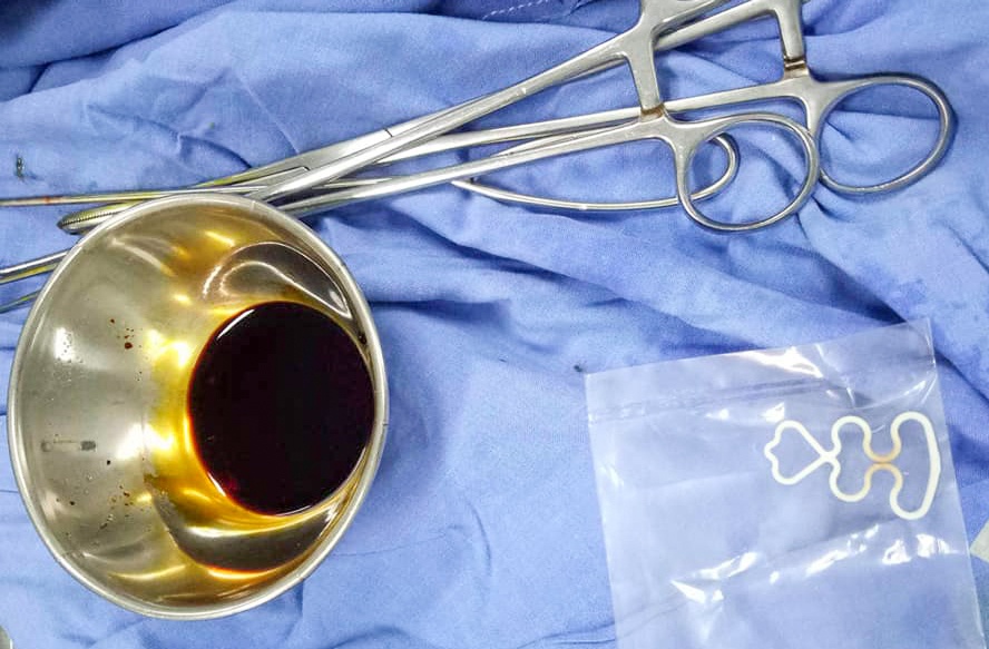 Thao vong tranh thai cho nguoi phu nu 70 tuoi hinh anh