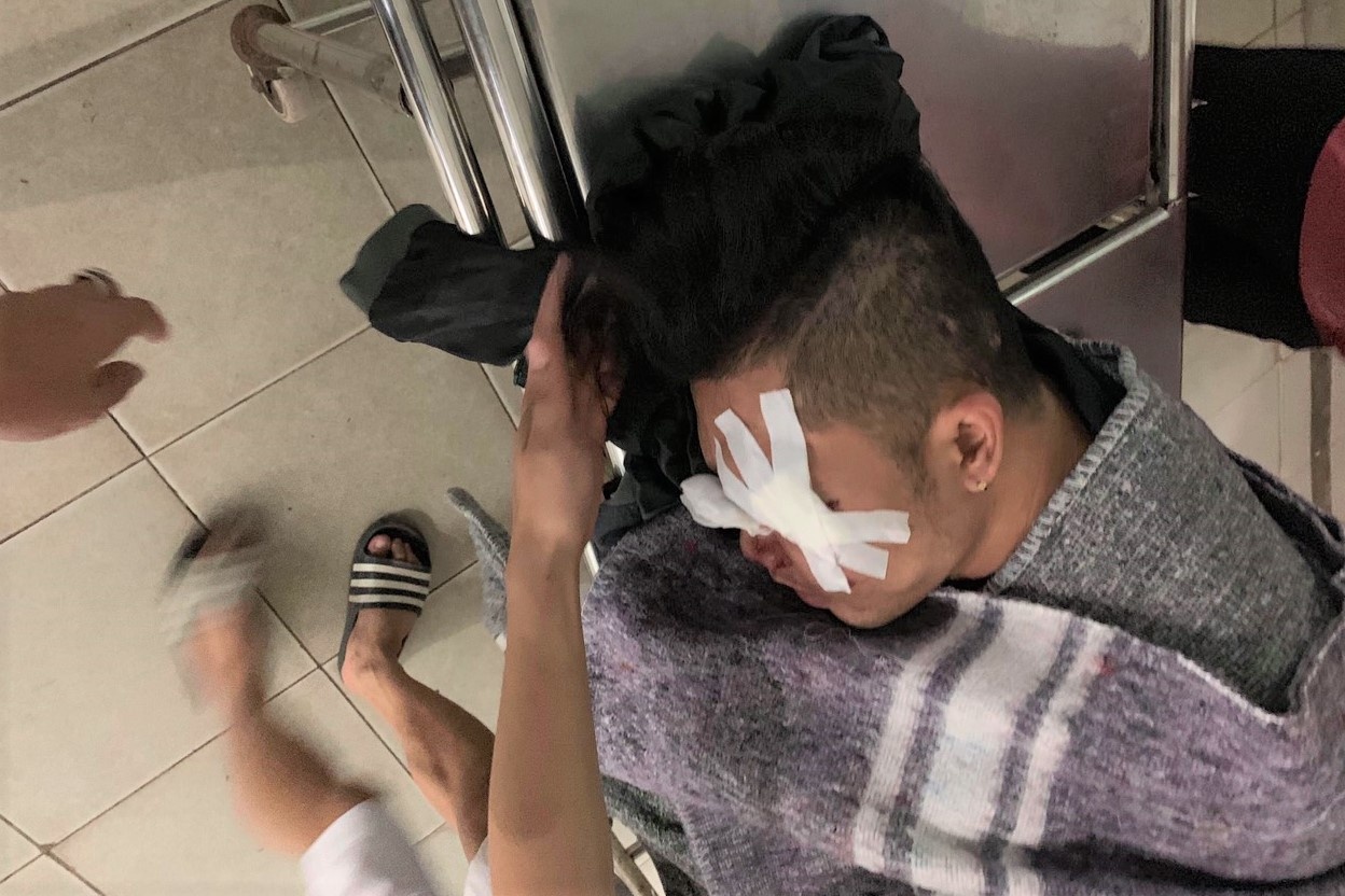 Nạn nhân nói về việc bị súng bắn vào mặt ở Hà Tĩnh. ảnh 1 Nan nhan noi ve viec bi sung ban vao mat o Ha Tinh. anh 1