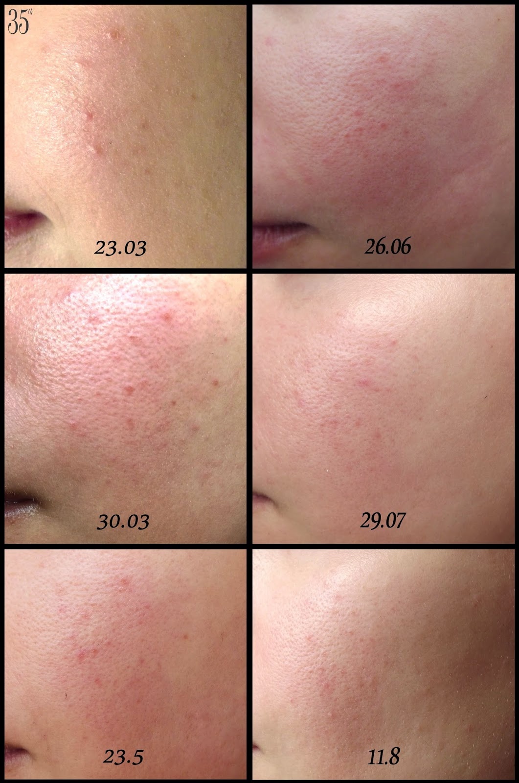 phân biệt da dị ứng và đẩy mụn ảnh 2 phan biet da di ung va day mun anh 2