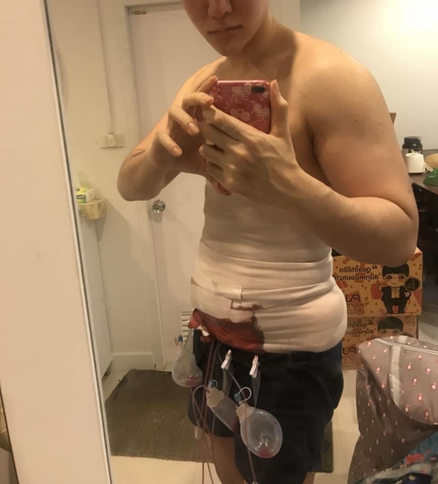 phau thuat bung 6 mui anh 10