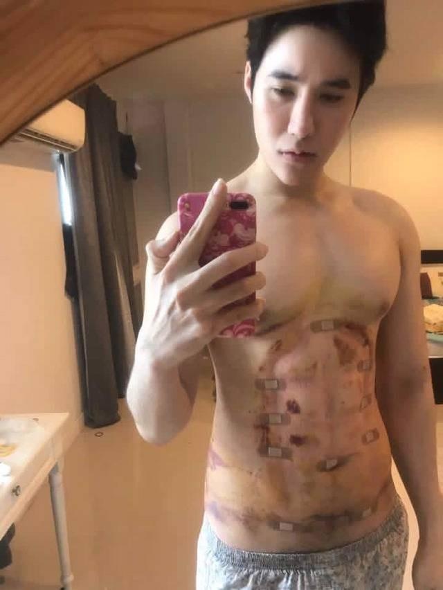 phau thuat bung 6 mui anh 11