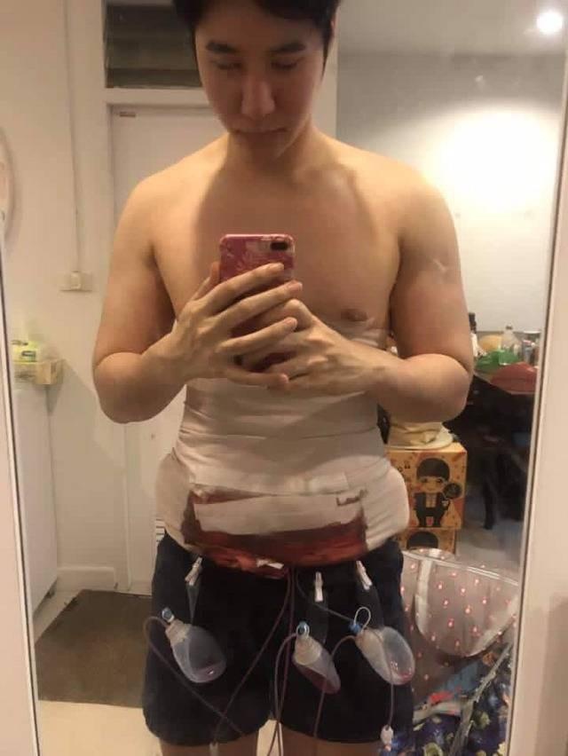 phau thuat bung 6 mui anh 9