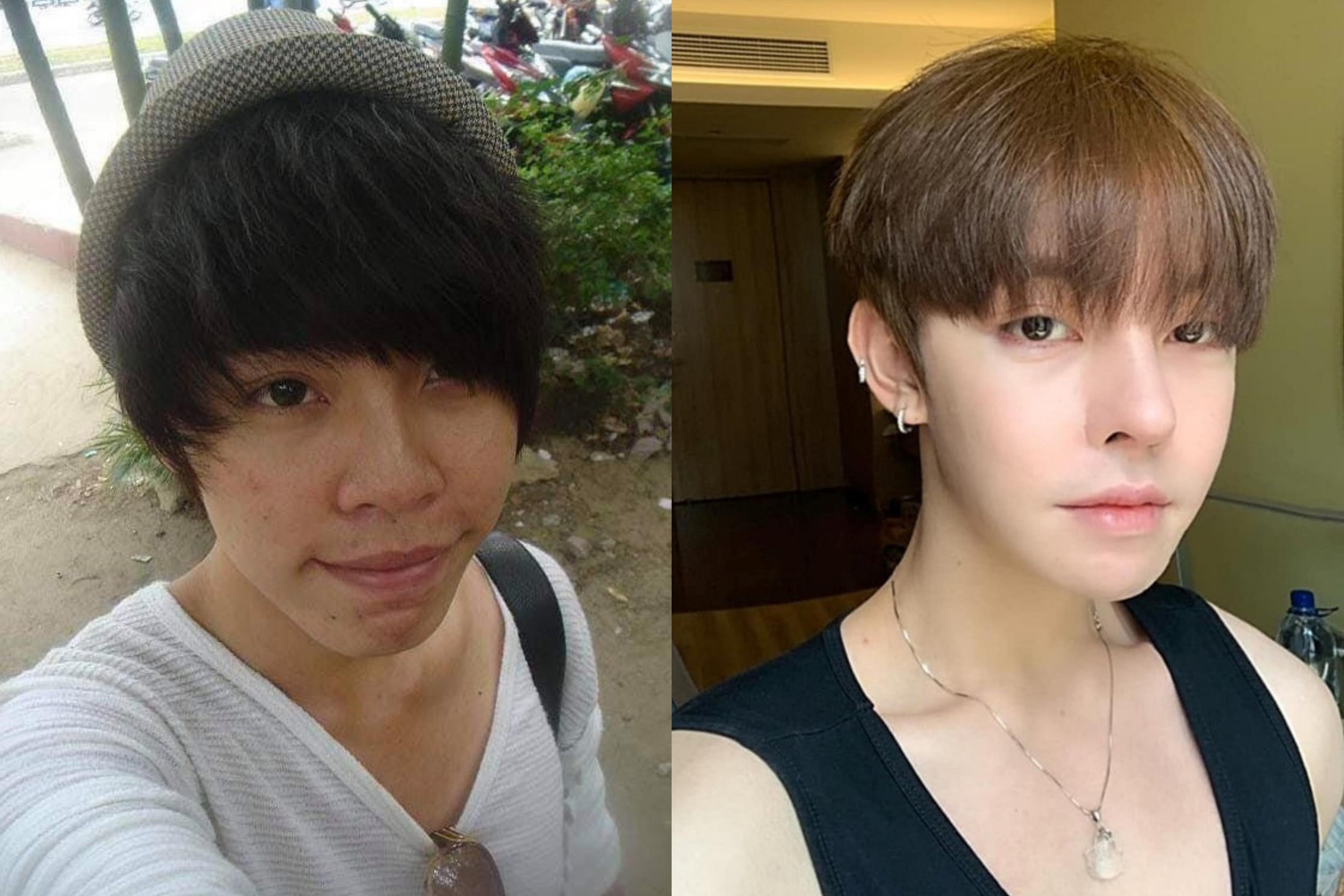 Nhung chang trai gay chu y vi cong khai qua trinh phau thuat tham my hinh anh