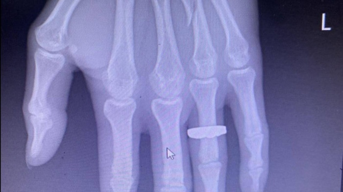 khach bi danh gay tay anh 3