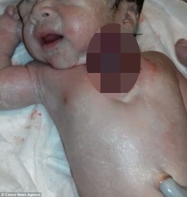 Em bé sinh ra với trái tim đập bên ngoài cơ thể ảnh 1 Em be sinh ra voi trai tim dap ben ngoai co the anh 1