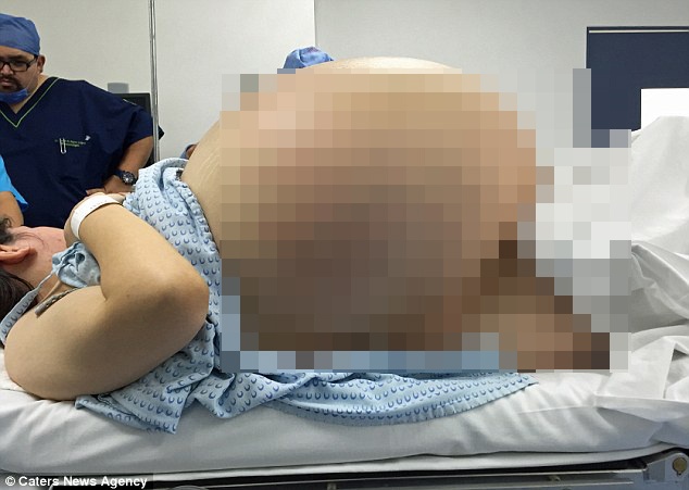 Nguoi phu nu mang khoi u nang buong trung nang 33 kg hinh anh