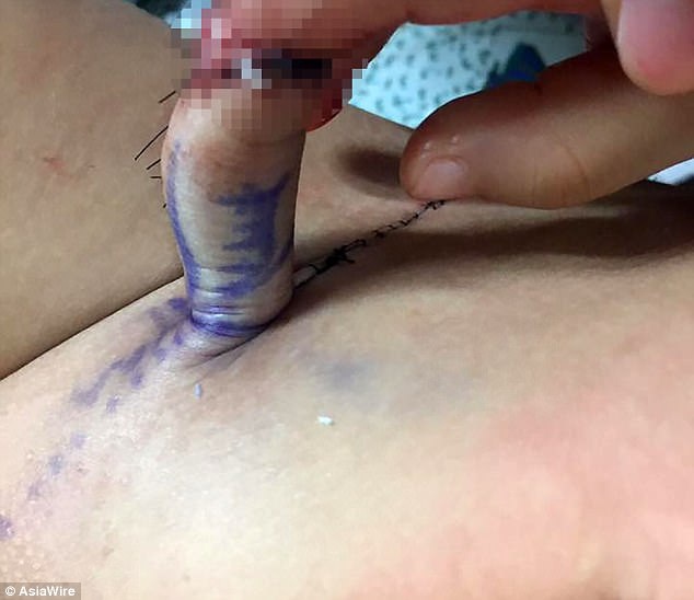 Noi tay bi ngua can dut vao bung de cho phau thuat anh 1