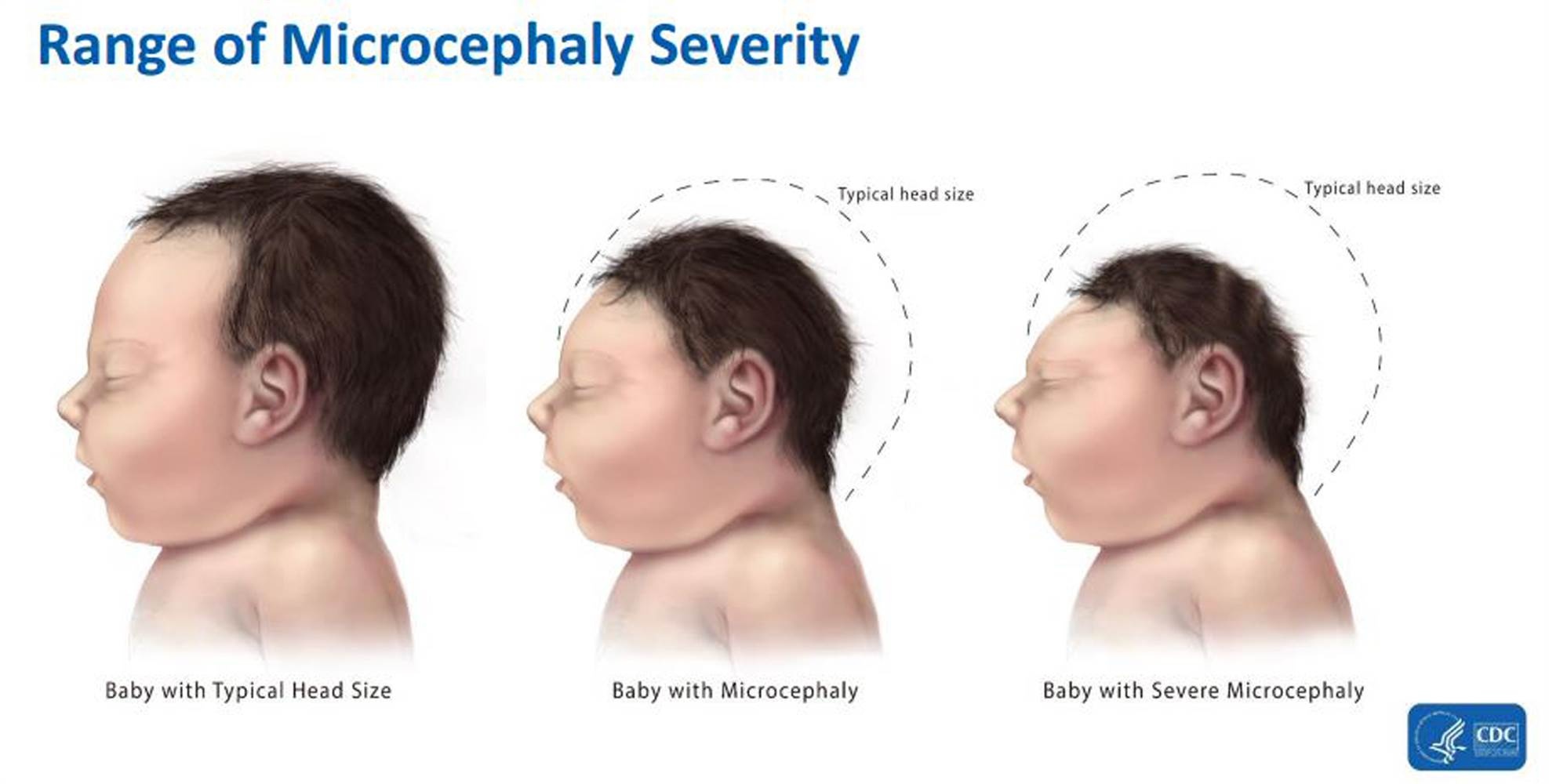 Vacxin phòng chống Zika đang được thử nghiệm ảnh 1 Vacxin phong chong Zika dang duoc thu nghiem anh 1