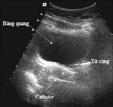 Bạn biết gì về tử cung nhi hóa? ảnh 1 Ban biet gi ve tu cung nhi hoa? anh 1