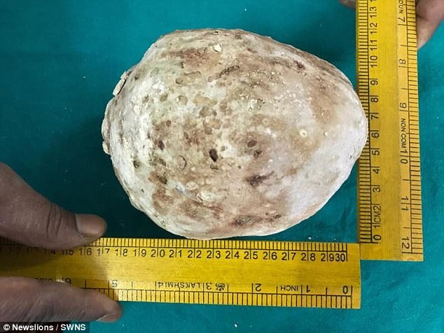 Phau thuat soi bang quang nang 1,4 kg hinh anh