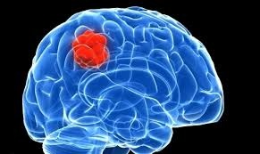 Phuong phap phau thuat u nao khong can tach hop so hinh anh