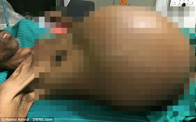 khối u sau phúc mạc ảnh 1 khoi u sau phuc mac anh 1