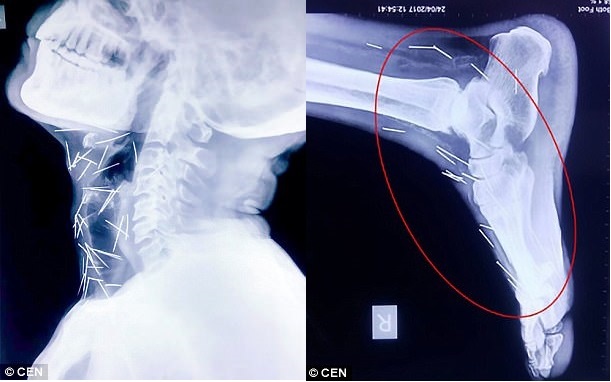 Benh nhan bi 75 chiec kim cam vao nguoi khong ro ly do hinh anh