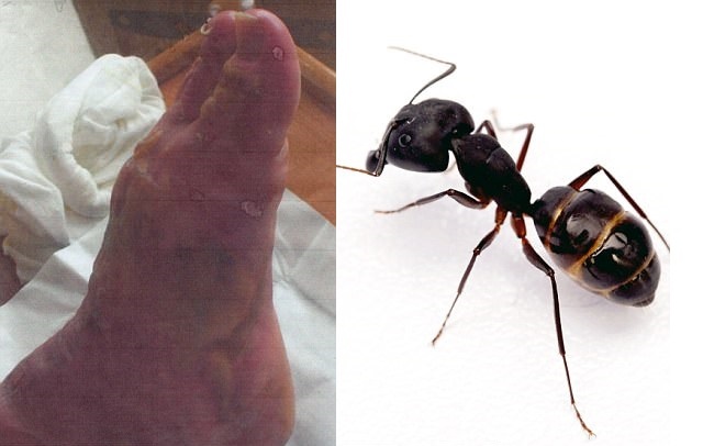 Dau don suot hai nam vi bi kien can hinh anh